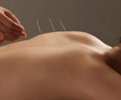 Get Effective Treatment and Natural Relief From Chronic Back Pain With Accupuncture In Manhattan