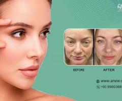 Eyelid Surgery In Whitefield, Bangalore At Anew