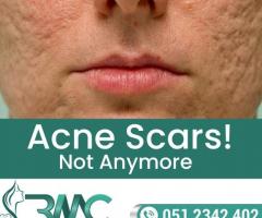 Best Acne Scars Removal Treatment in Islamabad - Rehman Medical Center