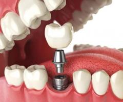 Get Your Smile Back! Affordable Dental Implants in South Carolina - Call Now!