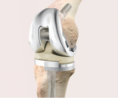 Revision Joint Replacement Surgery in Indore - Dr. Vinay Tantuway
