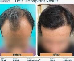 FUE Hair Transplant in Delhi By Dr. Jangid