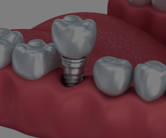 dental implant in Limassol - 1