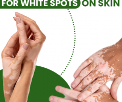 Cure any type of vitiligo in 30 days at home