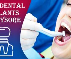 Best Dental Implants in Mysore | Best Implantologist