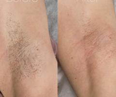 Underarm Waxing Excellence in Hilton Head Island at Spa Glow Wave