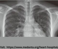 Cardiomegaly - Causes, Symptoms, & Treatment, | Medanta