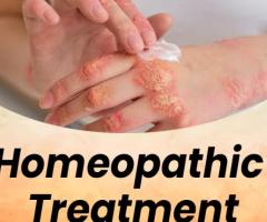 Natural Solutions: Exploring Homeopathic Remedies for Psoriasis Relief