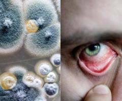 BLACK FUNGUS EYE TREATMENT IN INDORE | MUCORMYCOSIS