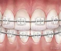 Achieving Perfect Alignment: Adult Orthodontic Treatment at Gibb Orthodontics - 1