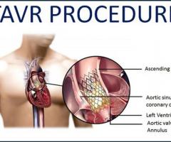 Transcatheter Aortic Valve Implantation (TAVI/ TAVR) Surgery - Procedure and Treatment | Medanta