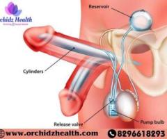 Orchidz Health: Top Penile Implant Surgery Cost in Bangalore