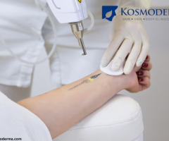 Advanced Laser Tattoo Removal in Bangalore - Premier Clinic at Kosmoderma