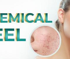 Chemical peel Treatment in Islamabad - Rehman Medical Center