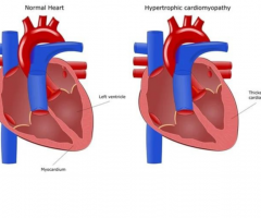 Cardiomyopathy Symptoms, Treatment, & Causes | Medanta
