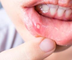 Healing Touch: Effective Ways to Cure Mouth Ulcers