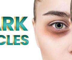 Dark Circles Under Eyes Causes and Treatment- Rehman Medical Center - 1