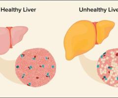 Exploring Ayurvedic Treatment For Fatty Liver