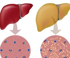 Explore Natural Treatment Options For Fatty Liver Relief - 1