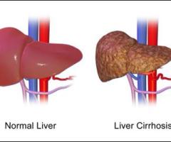 Discover Natural Ways to Treat Liver Cirrhosis