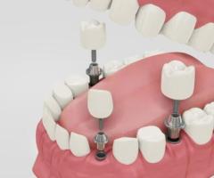 Transform Your Dental Experience with Nova Dental Hospital's Painless Root Canal Treatment - 1