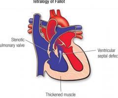 Tetralogy of Fallot (Congenital Heart Disease): Symptoms & Treatment