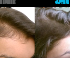 hair restoration fresno ca