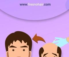 PRP Hair Therapy fresno - 1