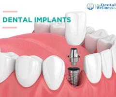 Restore Your Smile: Premier Dental Implants in Ahmedabad at Dental Wellness Center - 1