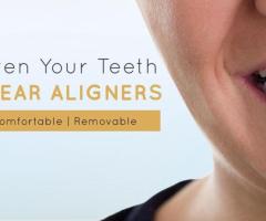 Clear Aligners at best price in Ahmedabad |Dental Wellness Center