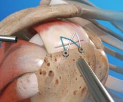 Book Your Appointment for Best Shoulder Arthroscopy in Delhi