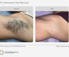 SHR Laser Hair Removal VIC | Waxing Queen Salon