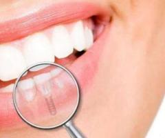 Dr. Vishal  Patel  Best Dental Implants in Ahmedabad | Dental Wellness center