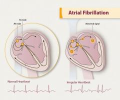 Atrial Fibrillation Causes, Symptoms - Treatment in India | Medanta