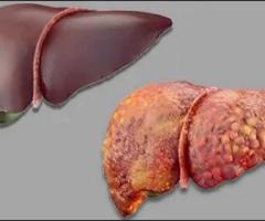 Liver Disease? Discover Ayurvedic Treatment Options