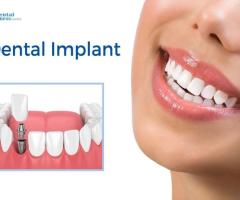 Get the Best Dental Implants Treatment  in Ahmedabad | Dental Wellness Center