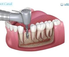 Root Canal Treatment by Experienced Dentist  Ahmedabad  | Dental Wellness Center
