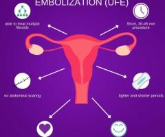 Subserosal Uterine Fibroids: Explore Innovative Solutions with USA Fibroid Centers