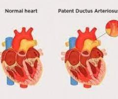 Patent Ductus Arteriosus Treatment, Symptoms, Open Heart Surgery