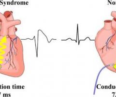 Brugada Syndrome Causes, Symptoms, Treatment in India
