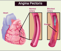 Angina Pectoris | Angina Pain Causes, Symptoms & Treatment