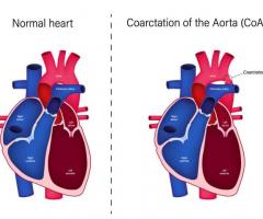 Coarctation of Aorta Causes, Symptoms, Treatment | Medanta