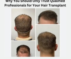 Why You Should Only Trust Experienced Professionals With Your Hair Transplant