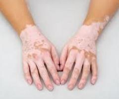 Vitiligo Treatment in India: Say Bye-Bye to Skin Diseases
