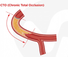 Total Recanalisation of Chronic Total Occlusion (CTO) Treatment