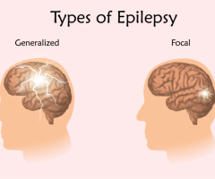 Epilepsy: Causes, Symptoms, Diagnosis and Treatment