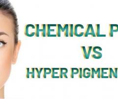 Chemical peel for Acne and Hyperpigmentation in Islamabad - R M C