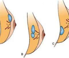 Breast Abscess Treatment, Causes, Symptoms & Surgery | Medanta