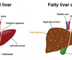 Homeopathy treatment for fatty liver disease in zirakpur - 24/7 homeopathy