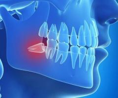 Wisdom tooth Extraction Treatment